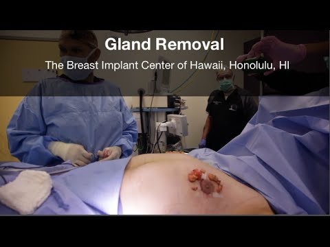 Male Breast Reduction Surgery Part 4 - The Operating Room - Gynecomastia Hawaii
