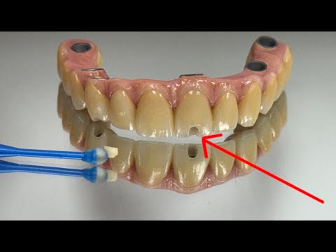 SYTON 7-Star | Masking a Facial, Central Anterior Access Hole