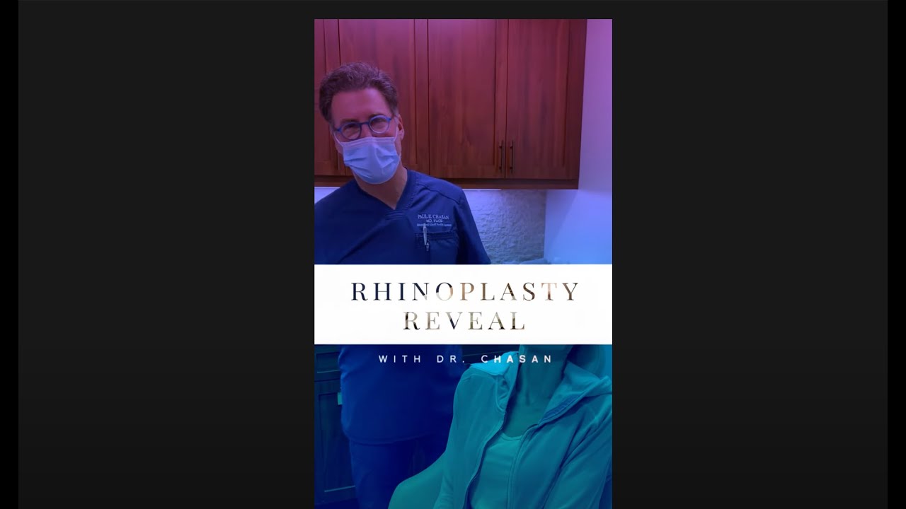 Rhinoplasty Reveal - #21
