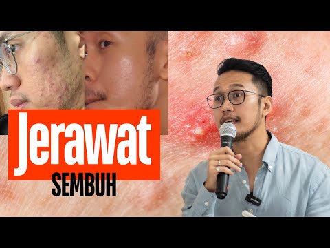 Cara supaya jerawat cepat sembuh