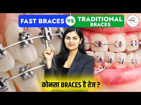 FAST Braces vs TRADITIONAL Braces! कौनसा है तेज़? Dr. Srishti Bhatia #braces #smilemakeover #smile