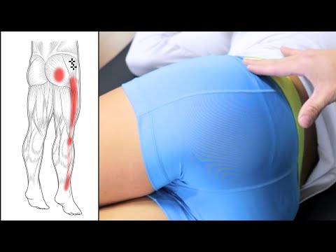 Upper Glute Pain in 2025? This One Small Muscle Is Often to Blame
