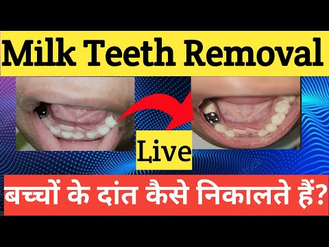 Milk Teeth Removal |Bacho Ke Dant |Dudh Ke Dant Kaise Nikalte Hai |Dant Nikalne Me Dard Hota Hai?