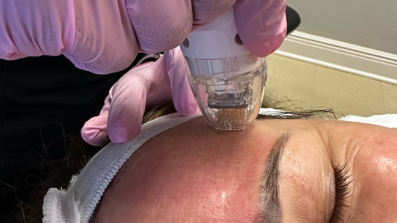 Microneedling treatment on a client's forehead.