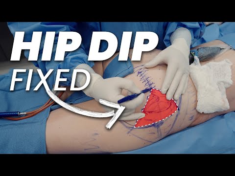 How to Fix Hip Dips: Real Results with Liposuction & Fat Transfer
