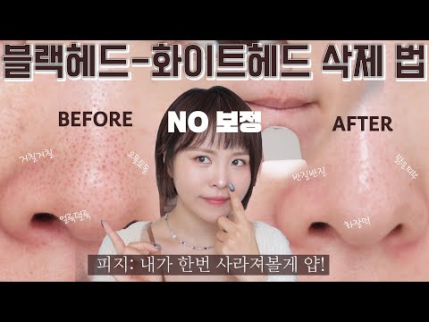 +🎁) 제발 코 피지 짜지 마세요!!NO보정-속이 다 시-원한 피지 없애는 법 👃🏻블랙헤드&화이트헤드 제거