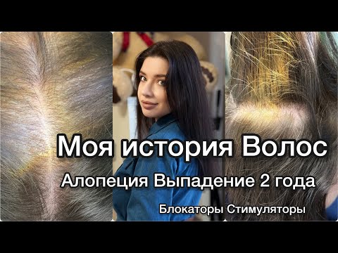❎ВСЕ ПРО ВЫПАДЕНИЕ ВОЛОС! Как НЕ ОБЛЫСЕТЬ? Алопеция. Диффузное выпадение волос. История моих волос.