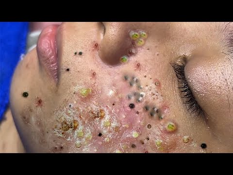 Big Cystic Acne Blackheads Extraction Blackheads & Milia, Whiteheads Removal Pimple Popping # 46638