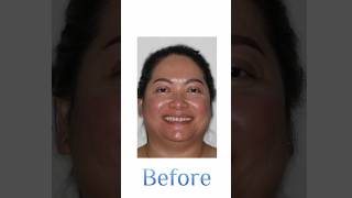 Gapped teeth braces transformation!