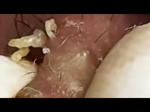Blackheads & Whiteheads Satisfying Removal @0615