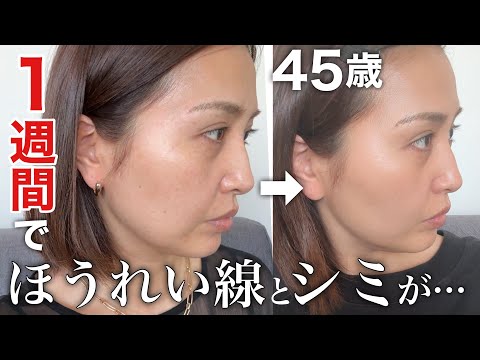 【40代50代】マジでほうれい線とシミが薄くなる♡ 1週間の経過をノーマルカメラで徹底レビュー！