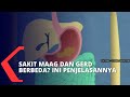 Faktor dan Gejala GERD