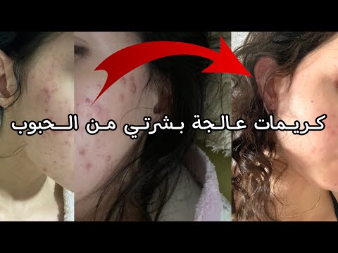 أفضل ٣ كريمات للبشرة المعرضة للحبوب 🙅🏻‍♀️| الكريمات اللي أنقذت بشرتي من ظهور الحبوب بشكل مستمر❗️