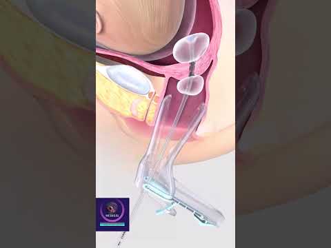Cervical Dilation & Curettage - Cervix Opening with Balloon #shorts