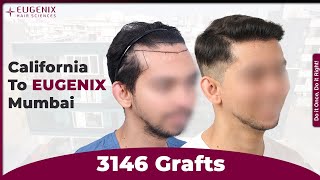 I Traveled From California To Mumbai For The Best Hair Transplant Results