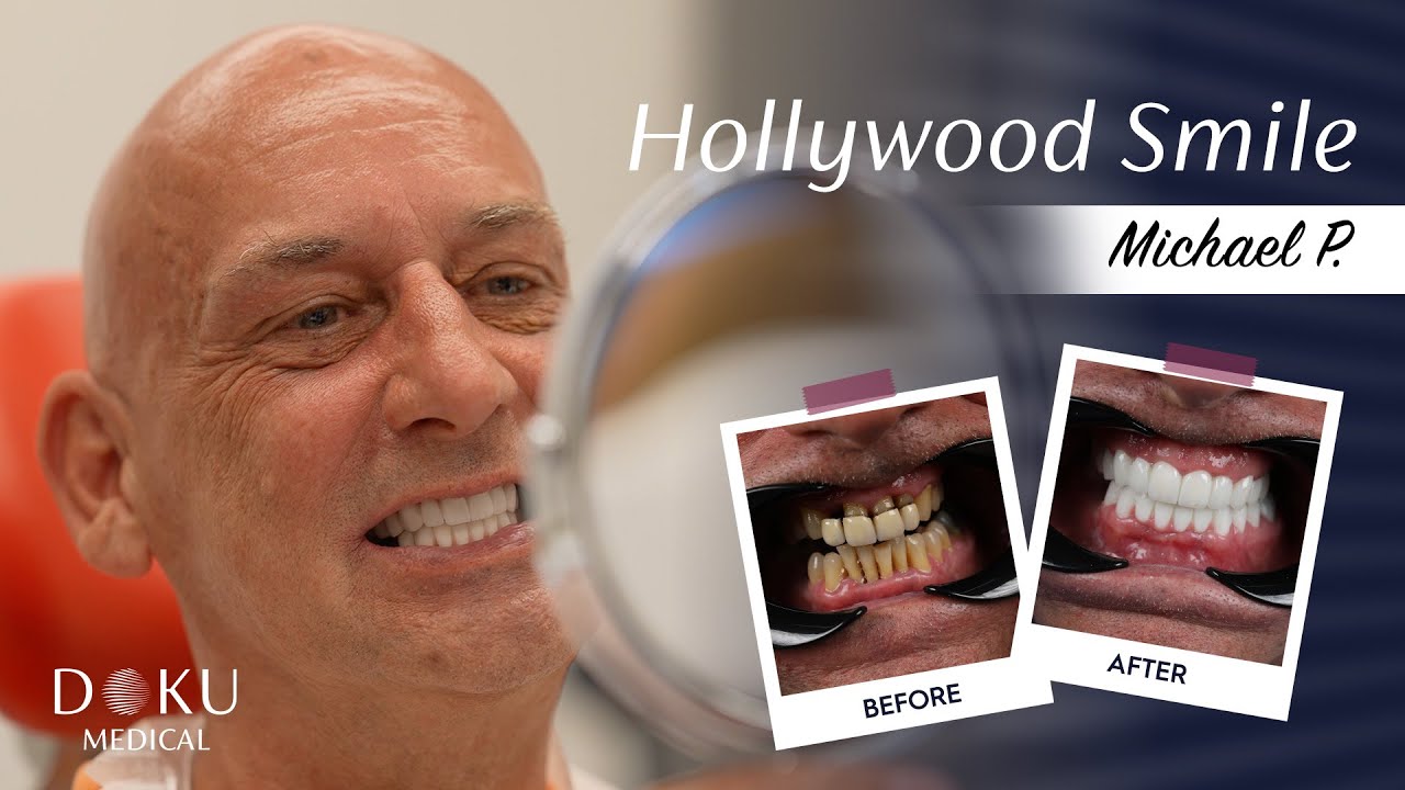 Hollywood Smile / Full Process – Patient’s POV