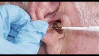 耳掃除の難聴 最大の耳垢除去23087