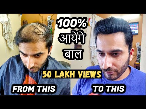 How to cure baldness/Ganjepan in male | 100% आयेंगे बाल | Hair Patch Solution | Born Creator