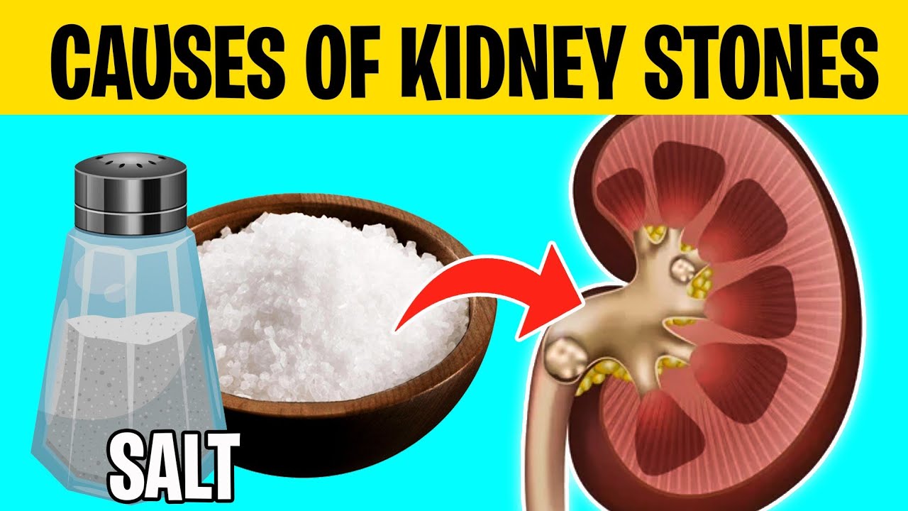 Top 10 Causes of Kidney Stones & How to Avoid Them