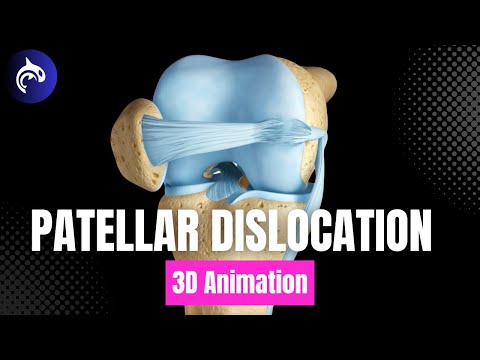 How Patellar Dislocation is treated: MPFL Reconstruction, Tibial Tubercle Osteotomy, Lateral Release