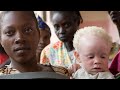 Albinism Awareness and Advocacy