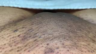 Ingrown Hair Removal Videos Kansas City Comic Con