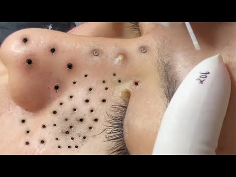 Big Cystic Acne Blackheads Extraction Blackheads & Milia, Whiteheads Removal Pimple Popping # 429