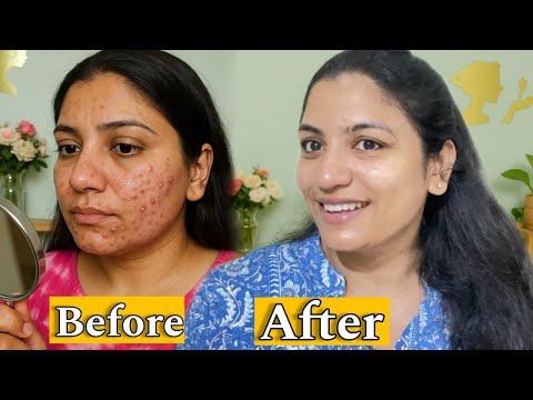 Dull & Damage ఐన Skin ని మళ్లీ Glow గా చేసుకోండి SkinCare Tips| Beauty tips in Telugu|Glowing skin