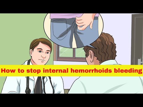 How to stop internal hemorrhoids bleeding naturally at...