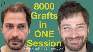 FUT Gigasession - Hair Transplant With 8143 Grafts