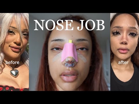 nose job vlog - 1 month update