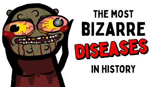 The Craziest Diseases in History
