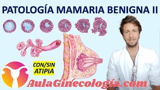 PATOLOGÍA BENIGNA DE LA MAMA II: FIBROADENOMA, PAPILOMA, HIPERPLASIA...  - Ginecología y obstetricia
