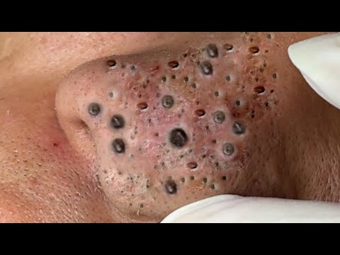 Extreme Blackhead Removal at LNG Skin Care # 65232