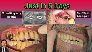 The Future of Dentistry: Upper Molar Implants in 5 Days with Corticobasal dental implant