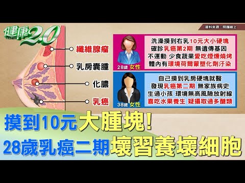 摸到10元大腫塊！28歲女乳癌二期 壞習養壞細胞 健康2.0