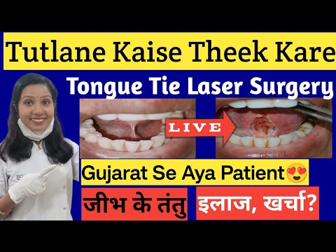 Tutlana Kaise Thik Kare |तुतलाने का इलाज |Tongue Tie |Jibh Ke Tantu Ka Ilaj |Cost Of Laser Surgery?