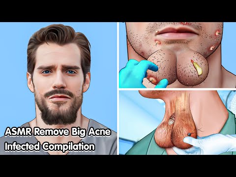 ASMR Remove Big acne, Dogtick Infected Compilation - Deep Cleaning Animation