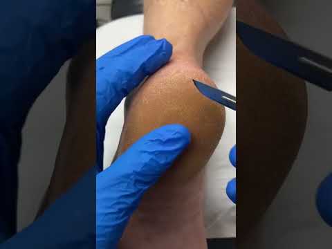 Thick Heel Callus Removal by Australian Podiatrist | Effective Treatment for Calluses and Corns