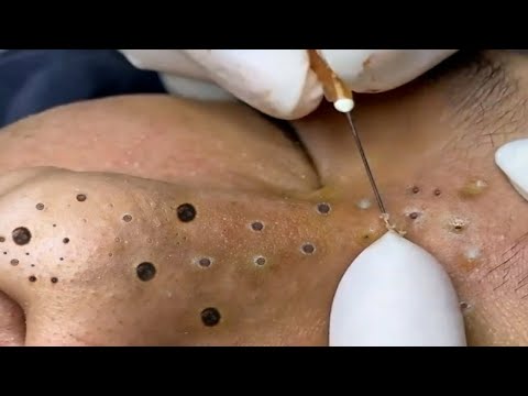 Blackheads & Acne Treatment Latest Update 2710