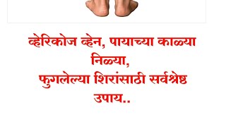 व्हीजेरीकोज व्हेन चा त्रास असेल, तर हे 3 उपाय करू शकता.