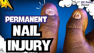 Permanent Nail Injury