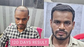 4 Months Hair Transplant Result | 120 Days Hair Transplant Results | Hair Transplant Ranchi