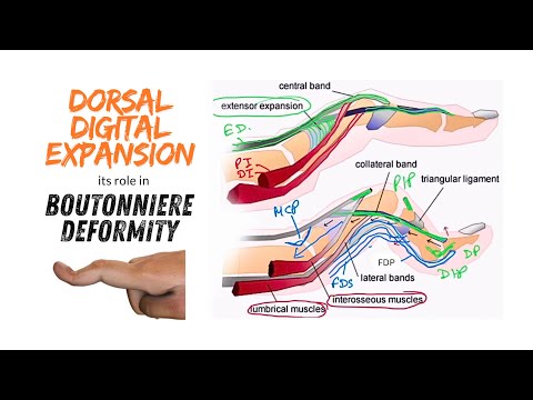 Formation of dorsal digital expansion and its role in Boutonniere deformity