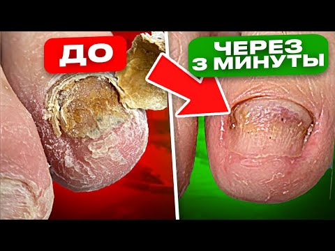 Грибок ногтей УХОДИТ за 3 МИН! 1 Простое Средство, Которое Есть У КАЖДОГО (10 рецептов)