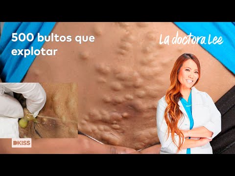500 bultos por todo el cuerpo |La doctora Lee