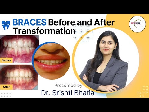 BRACES Before and After Transformation: Dr. Srishti Bhatia #braces #smilemakeover