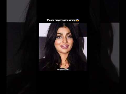 Celebrities plastic surgery has gone wrong but not adity's 😍😱 #shortsfeed #shorts #viral #trending