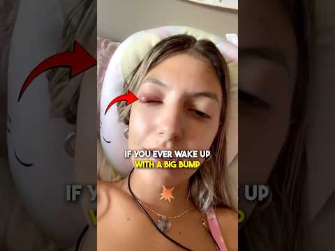 Eye Infection 🤯