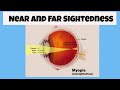 Understanding Nearsightedness and Farsightedness